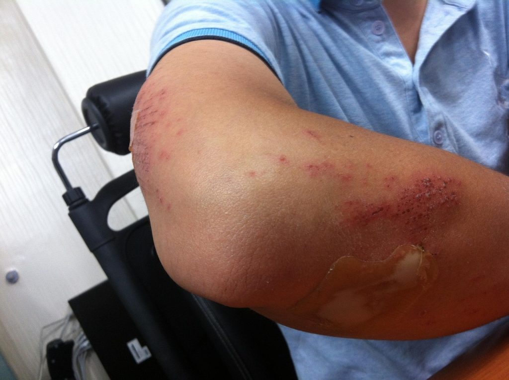 injury